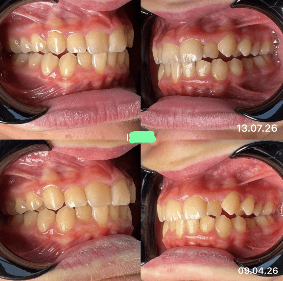 Vergleichsfoto nach 8 Wochen Behandlung